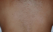 Laser hair removal 5 months after 1 treatment