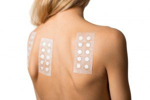 Woman with allergy patch test on her back
