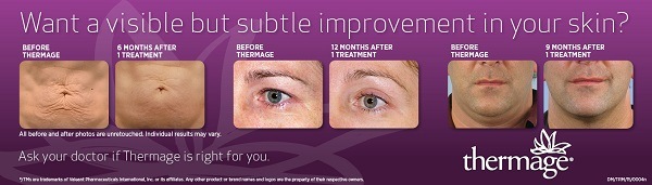 Example of Thermage treatment results on face and body