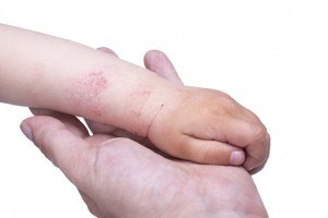 Eczema on kid's hand