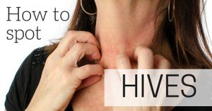 How to spot hives