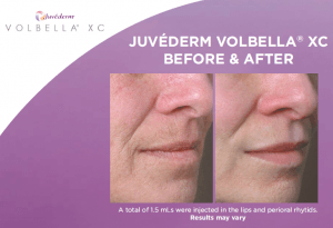 Before and after photos of Juvederm Volbella treatment