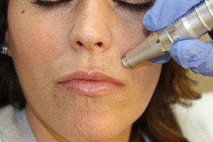 Woman treated with microneedling