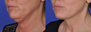 Before and after photos of woman's jawline treated with Thermi