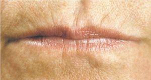 Photo of lip lines