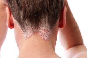 Photo of psoriasis on the hairline and on the scalp