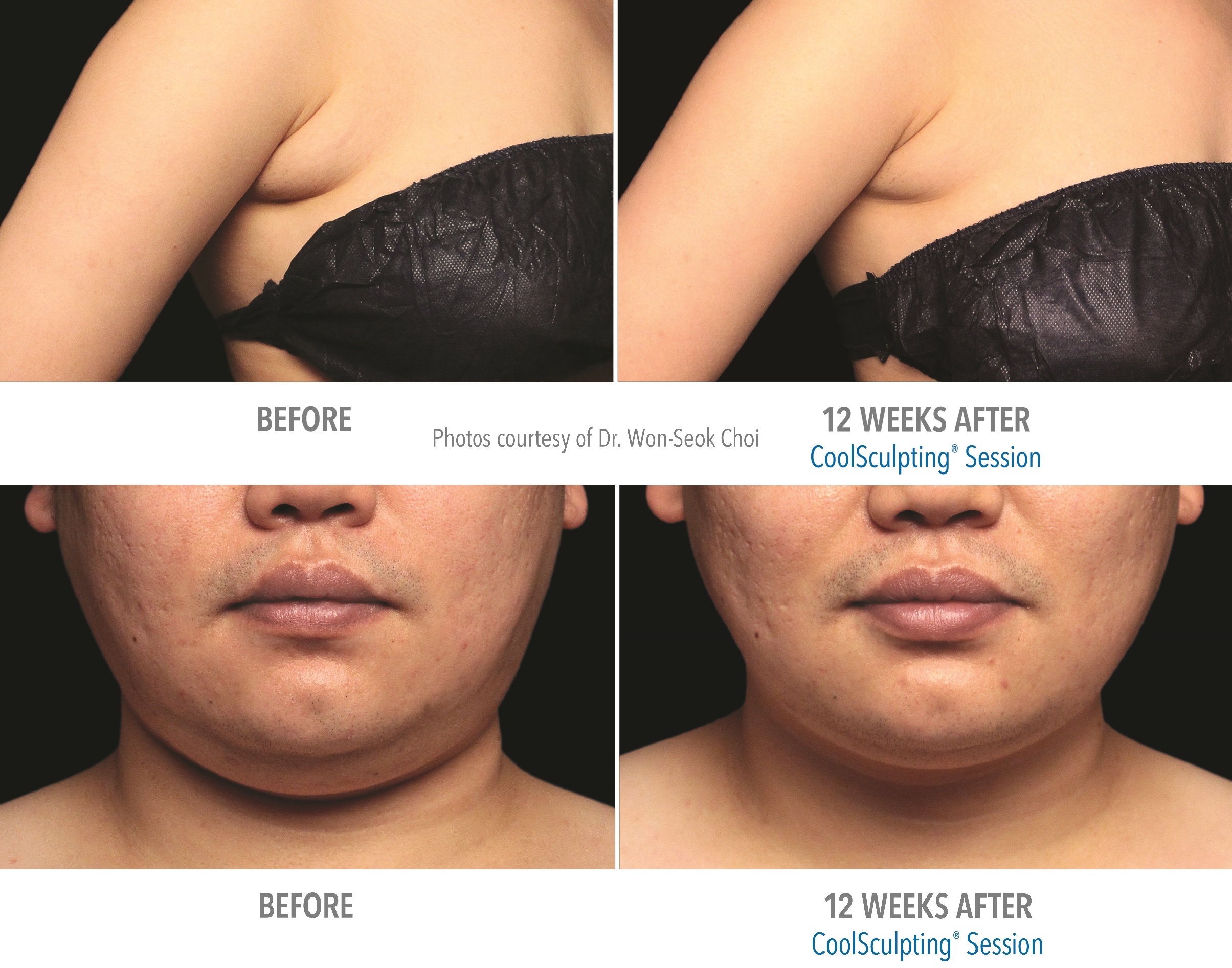 Before & After photos of underarm bulge and double chin treated with CoolScupting