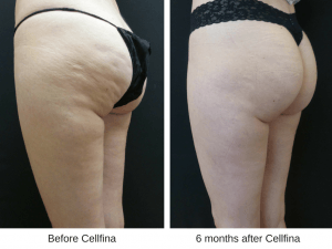 Before and after photos of Cellfina treatment for cellulite