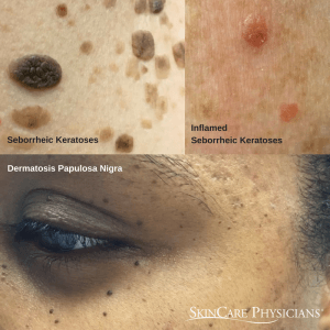 Examples of common skin growths called seborrheic keratoses