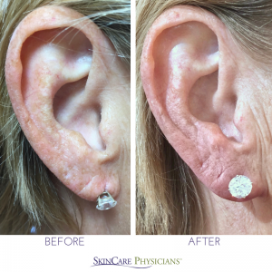 Before and after photos of earlobe treated with dermal filler 
