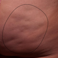 Before Cellfina treatment for cellulite