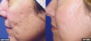 Before and after photos of acne scars treated with Fraxel laser