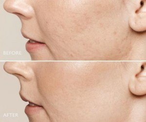 Before and after photos of acne scars treated with Restylane