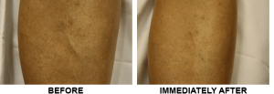 Before-after sclerotherapy treatment on shin vein
