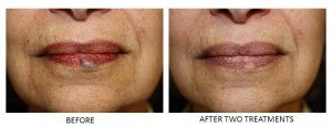 Venous lake before and after two laser treatments