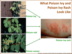 What Poison Ivy and Poison Ivy Rash Look Like