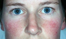 Before pulsed dye laser treatment
