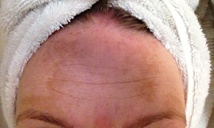 Before melasma treatment of forehead