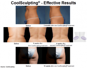 Consistent and effective results with CoolSculpting