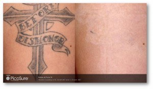 Tattoo removal with new PicoSure laser