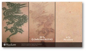 Tattoo removal results using Picosure and Q-Switched Nd:YAG