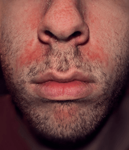 Photo of seborrheric dermatitis above the lips