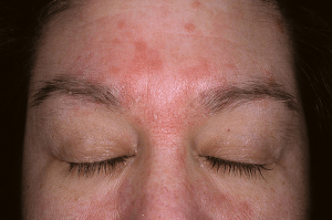 Photo of seborrheric dermatitis on forehead