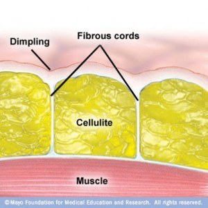 What causes cellulite