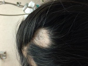 Photo of pronounced hair loss due to alopecia