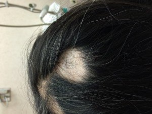 Hair falling out discount