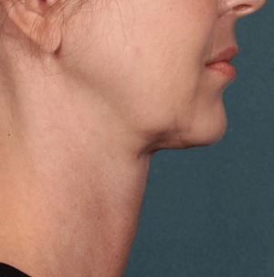 Profile photo after Kybella treatment