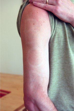 Marathoner skin sun damage a year later 