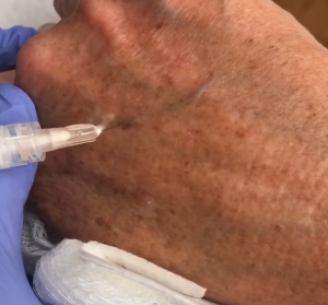 Hand vein treated with sclerotherapy