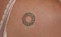 Before Laser Tattoo Removal