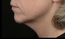 6 months after Thermage radiofrequency treatment