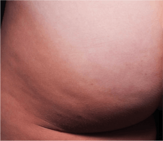 After one cellulite procedure