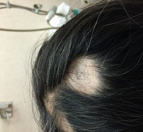 Photo of pronounced hair loss due to alopecia