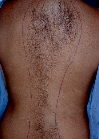 Before hair laser removal treatment