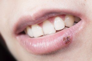 Cold sore on lip