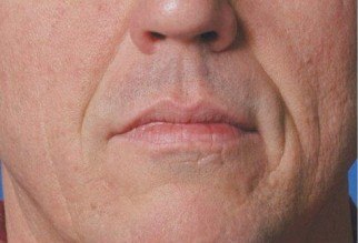 Nasolabial folds before Restylane injectable filler treatment