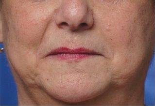 Nasolabial folds before Restylane injectable filler treatment