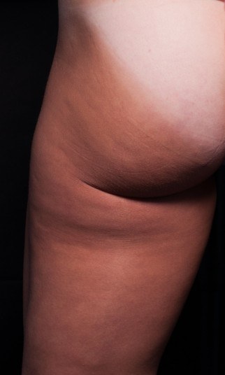 After one cellulite procedure