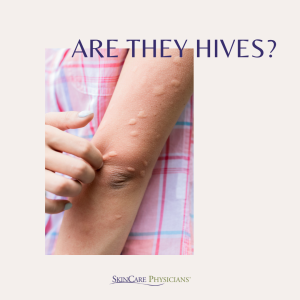 Hives on a woman arm