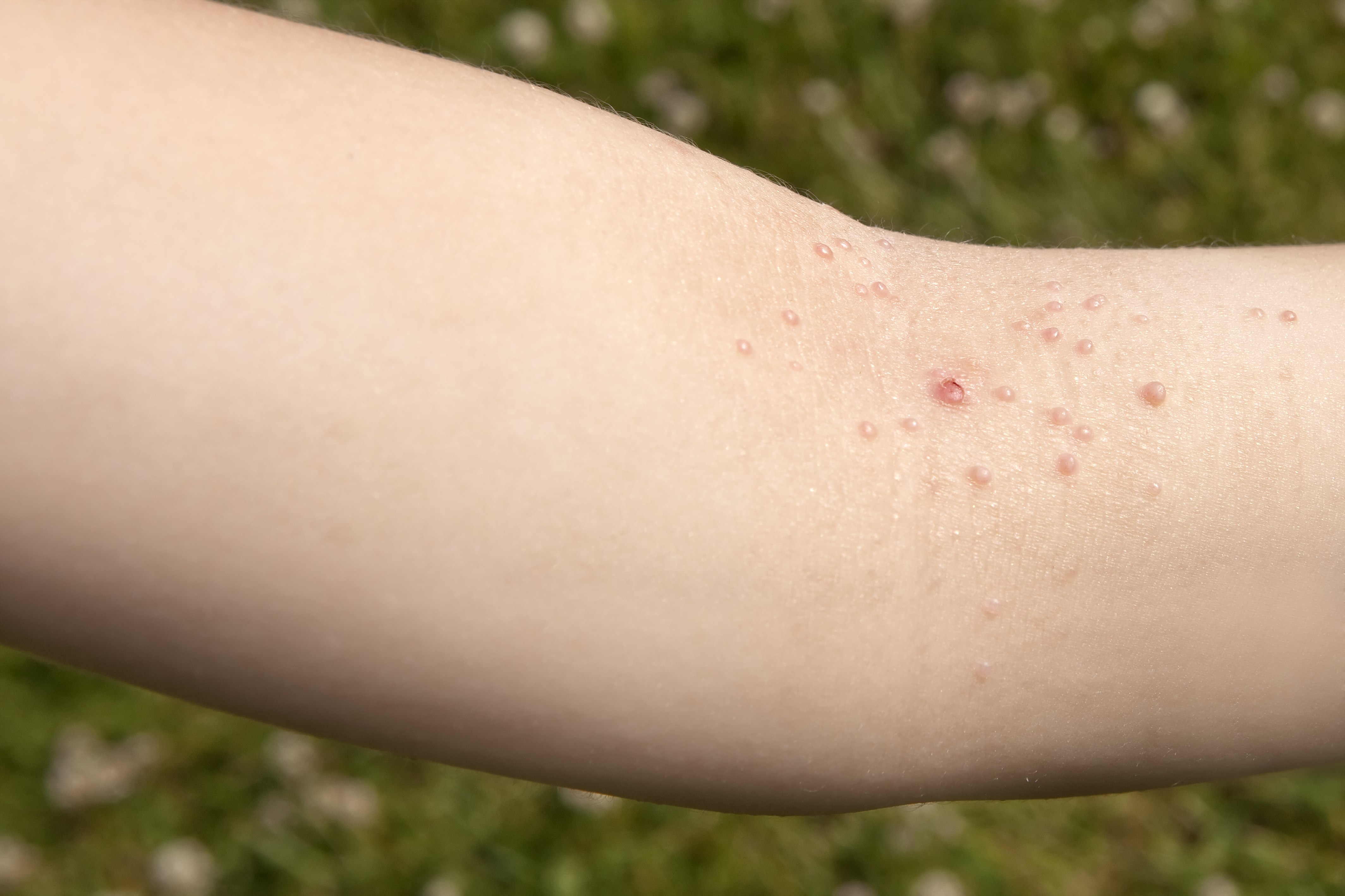 Molluscum on sale contagiosum treatment