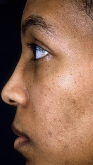 16 weeks after acne scars treatment