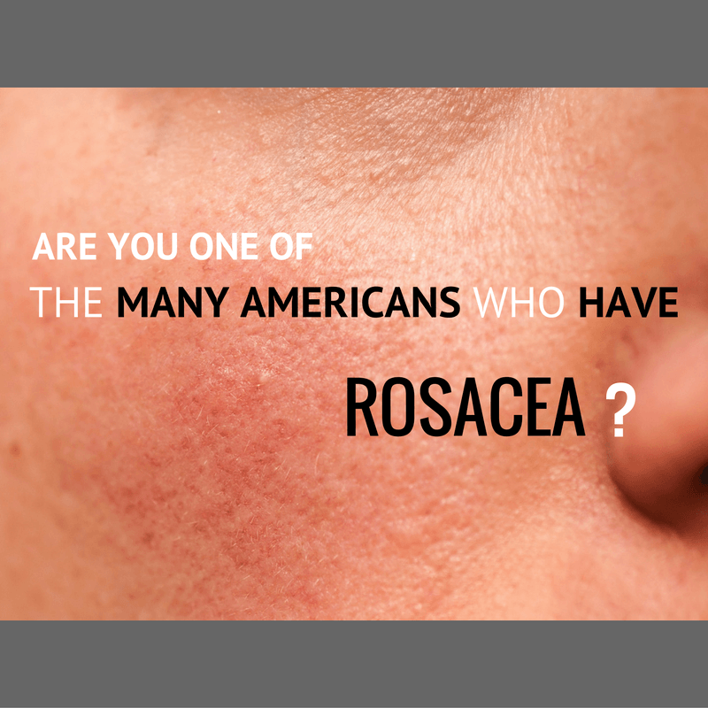 Are you one of the many Americans who have rosacea