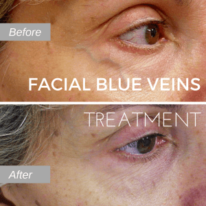 Before and after photo of facial blue vein