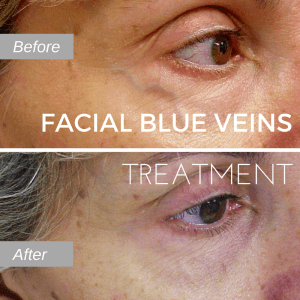 Before and after photos of facial blue vein
