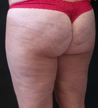 After one cellulite treatment, 3 months post procedure