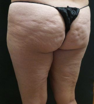 Before cellulite treatment